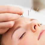 acupuncture in ottawa